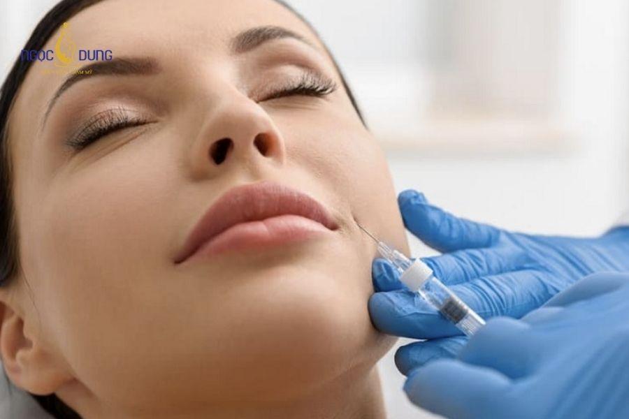 Tiêm filler rãnh cười: Hiệu quả, bảng giá, duy trì 13 Kết quả thẩm mỹ mềm mại tự nhiên ngay sau khi kết thúc liệu trình thực hiện