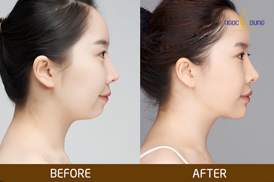 Tiêm filler cằm giá bao nhiêu? Bảng giá cập nhật mới 15 Kết quả tiêm filler cằm giúp cải thiện độ nhô, làm rõ đường viền hàm và tạo góc nghiêng thanh thoát