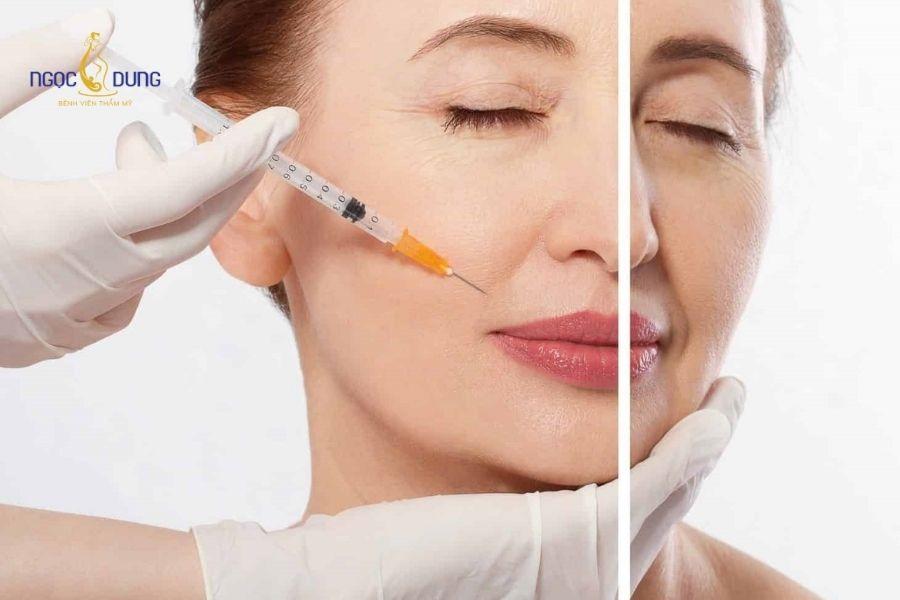 Tiêm filler rãnh cười bao nhiêu cc? Bảng giá chi tiết 18 Khách hàng có nếp gấp mũi má rõ nét thích hợp thực hiện phương pháp tiêm filler trẻ hóa