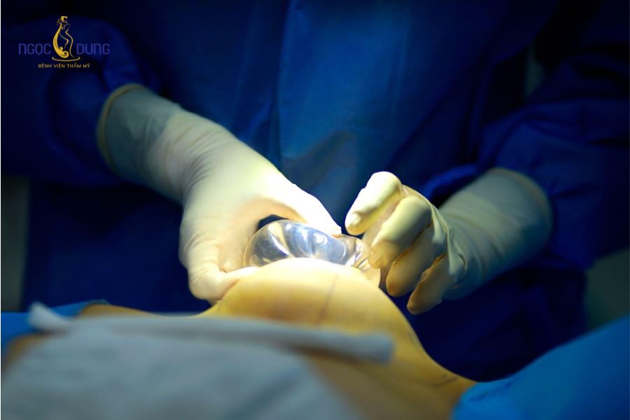 Nâng ngực có cho con bú được không? Giải đáp chi tiết 14 Kỹ thuật mổ, vị trí đặt túi và loại túi ngực là các yếu tố quyết định khả năng tiết sữa hậu phẫu