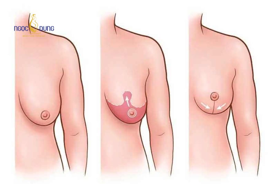 Nâng ngực chảy xệ sau sinh: Giải pháp lấy lại vòng 1 săn chắc 15 Kỹ thuật ngoại khoa treo sa trễ giúp loại bỏ da chùng thừa và tạo dựng phom dáng bầu ngực thon gọn