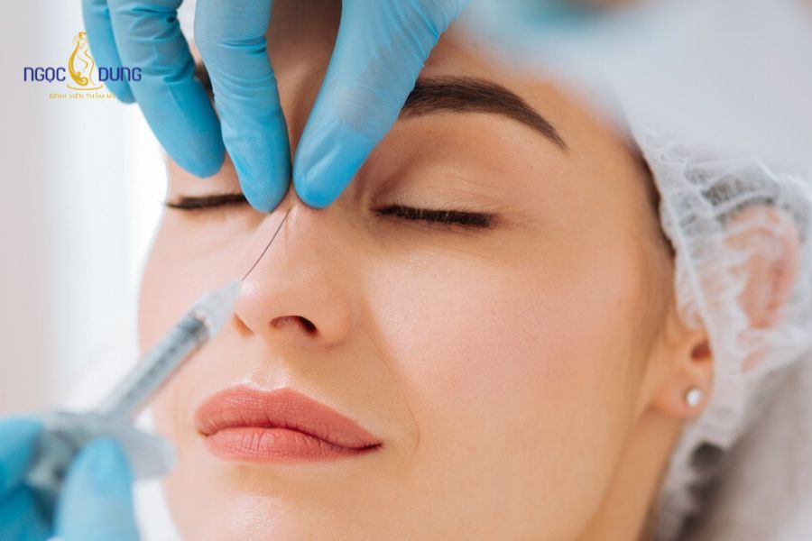 Tiêm filler mũi bị tràn: Nguyên nhân và cách khắc phục 13 Kỹ thuật tiêm enzym Hyaluronidase phân hủy chất làm đầy HA bị tràn