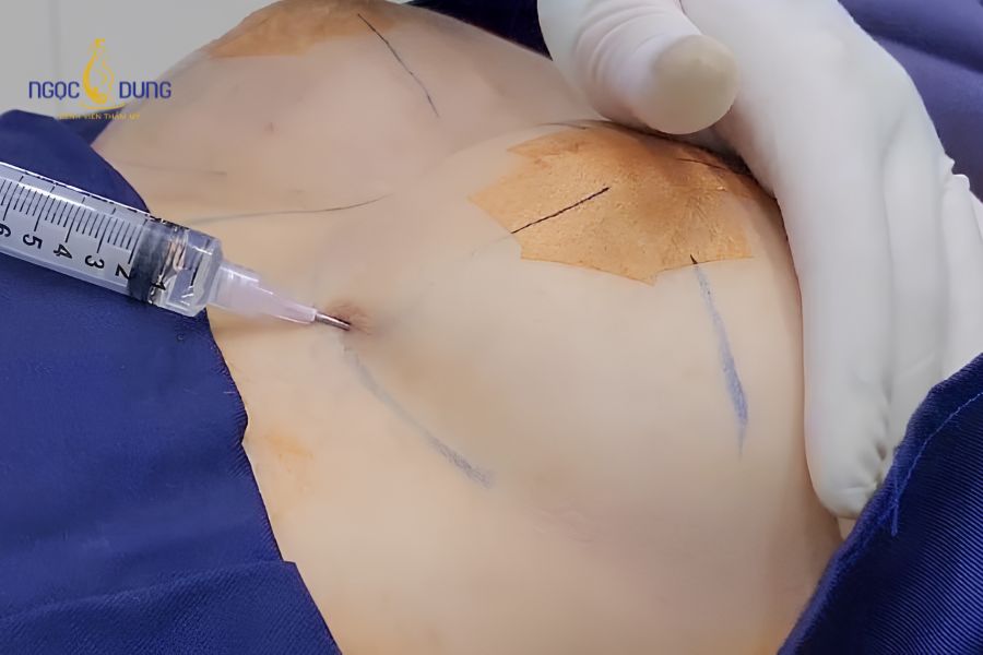 Các phương pháp nâng ngực không đặt túi: Hướng dẫn chi tiết 9 Kỹ thuật tiêm filler bổ sung thể tích mô ngực tức thì không qua phẫu thuật rạch mổ