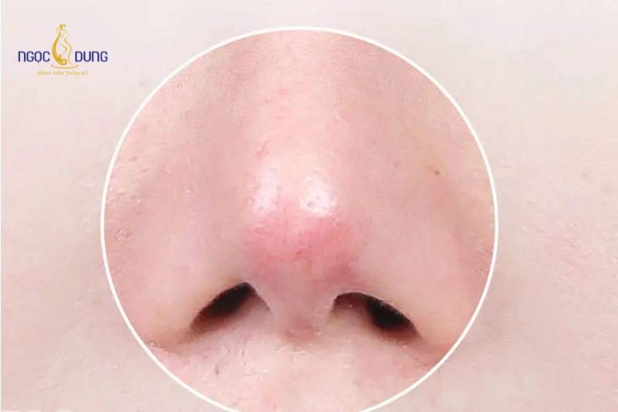 Tiêm filler mũi bị đỏ: Nguyên nhân và cách xử lý hợp lý 12 Kỹ thuật tiêm thiếu chính xác đâm nhầm lòng mạch máu gây tắc nghẽn nuôi dưỡng mô