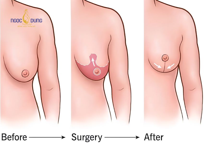Nâng ngực sa trễ không đặt túi: Bảng giá và quy trình 9 Kỹ thuật treo ngực sa trễ không đặt túi giúp định hình lại bầu ngực cao thon tự nhiên