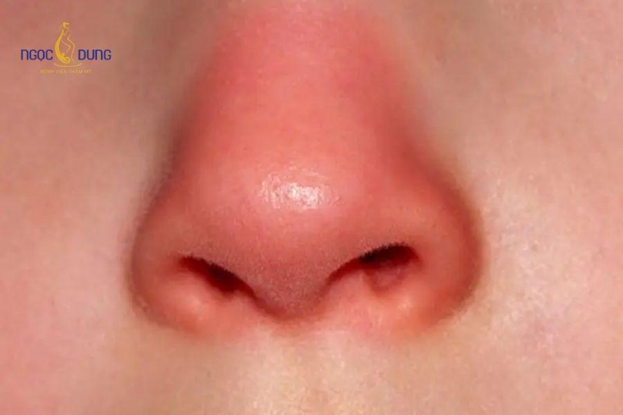 Tiêm filler rồi có nâng mũi được không? Cần lưu ý gì? 12 Loại bỏ chất làm đầy cũ hỗ trợ phòng ngừa biến chứng chèn ép mô và bóng đỏ đầu mũi