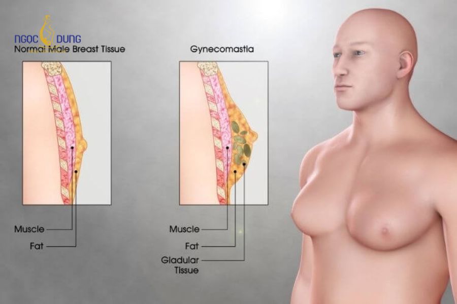 Nâng ngực cho nam giới: Giải pháp vóc dáng nam tính hơn 14 Loại bỏ mô tuyến vú phì đại giúp phẳng phiu và định hình lại vóc dáng nam giới