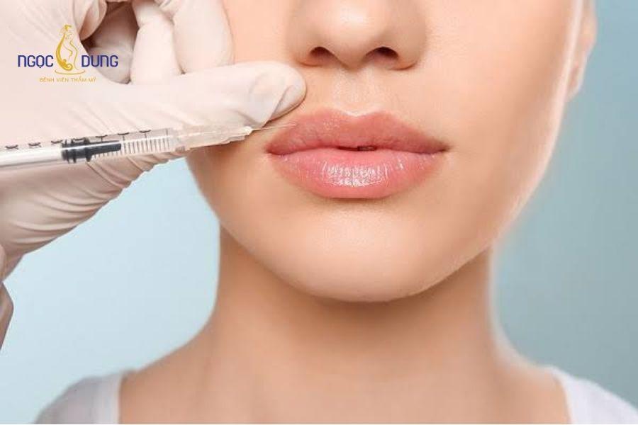 Tiêm filler rãnh cười bao nhiêu cc? Bảng giá chi tiết 20 Lựa chọn kết cấu chất làm đầy phù hợp với độ đàn hồi của mô da vùng rãnh mũi má