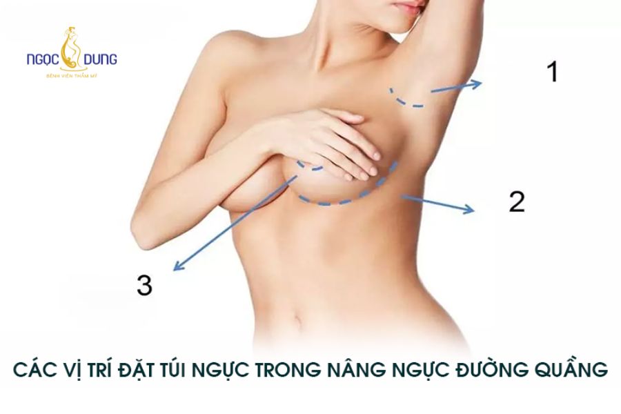 Nâng ngực bằng túi độn: Giải pháp, chi phí và quy trình 17 Minh họa các vị trí đường rạch da phổ biến trong phẫu thuật nâng ngực bằng túi độn