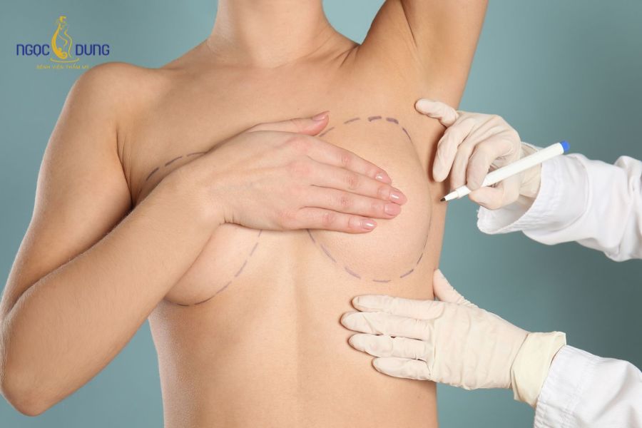 Nâng ngực bằng túi độn: Giải pháp, chi phí và quy trình 11 Mô phỏng vị trí đặt túi độn ngực giúp kiến tạo bầu ngực căng tròn, cân đối