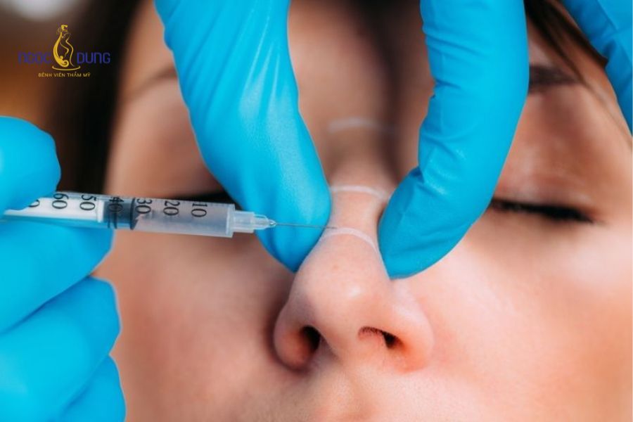 Tiêm filler mũi có đeo kính được không? Cần lưu ý gì? 10 Mốc thời gian kiêng cữ đeo kính gọng trung bình từ 1 đến 2 tuần tùy thuộc vào cơ địa và tốc độ gom phom mũi