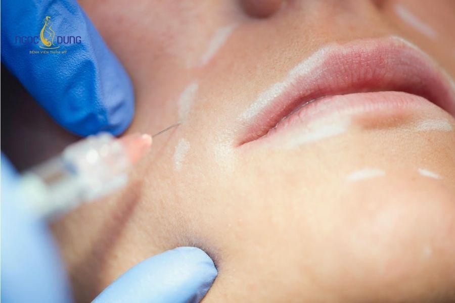 Tiêm filler rãnh cười bao nhiêu cc? Bảng giá chi tiết 12 Mức cc filler tiêm rãnh cười được điều chỉnh dựa trên độ sâu nếp gấp mũi má thực tế của từng khách hàng