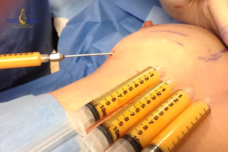 Nâng ngực nội sinh là gì? Ưu nhược điểm và quy trình 13 Nâng ngực bằng mỡ tự thân mang lại bầu ngực mềm mại và hạn chế để lại sẹo