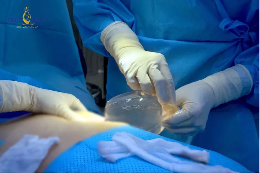 Nâng ngực đường quầng là gì? Ưu nhược điểm và quy trình 14 Nâng ngực đường chân ngực cho thao tác đặt túi cẩn trọng và rút ngắn thời gian hồi phục