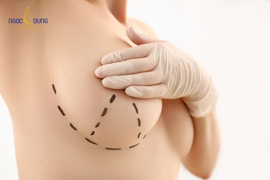 Phẫu thuật nâng ngực đường nào tốt và an toàn nhất? 12 Nâng ngực đường quầng vú ứng dụng vết mổ tại ranh giới chuyển màu quầng vú