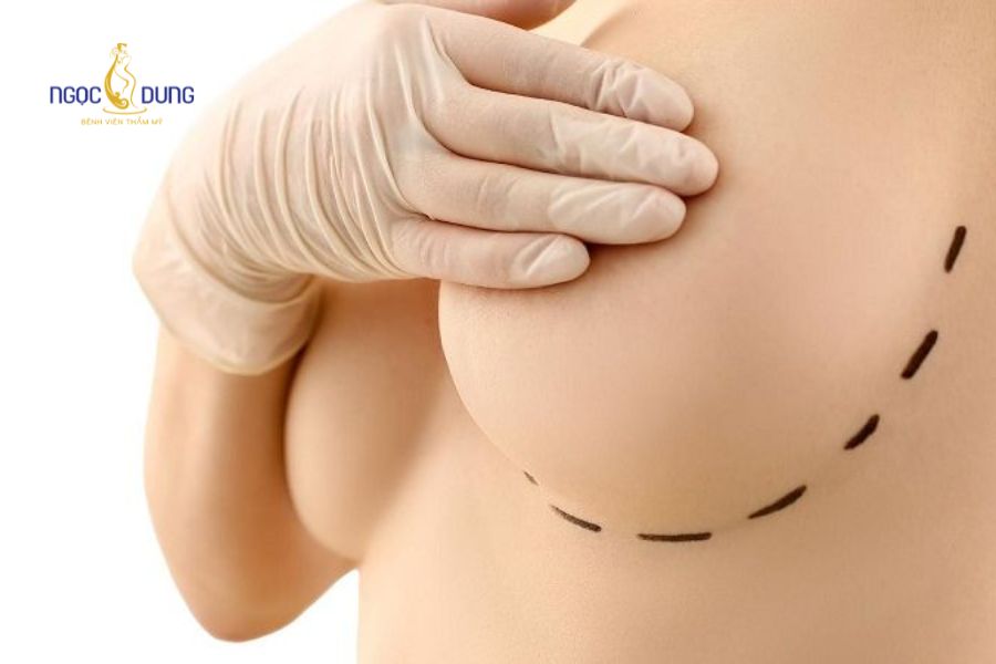Nâng ngực giọt nước: Giải pháp vòng 1 căng tròn tự nhiên 18 Nâng ngực giọt nước phù hợp với đa dạng nhu cầu làm đẹp
