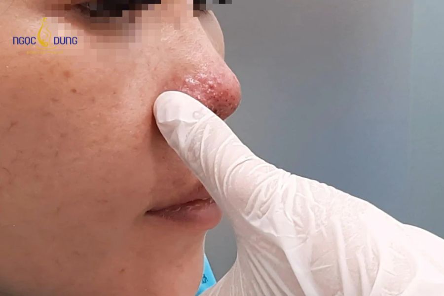 Tiêm filler mũi bị sưng: Bao lâu hết và cách giảm sưng 15 Nhận diện sớm các biến chứng y khoa nguy hiểm để chủ động thăm khám bác sĩ can thiệp kịp thời