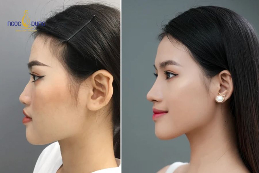 Nên độn cằm hay tiêm filler? Giải đáp từ chuyên gia 11 Phẫu thuật độn cằm giúp khắc phục cằm lẹm nặng và duy trì dáng cằm ổn định lâu dài