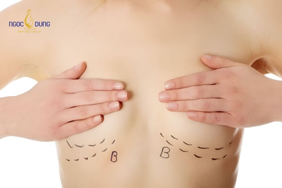 Nâng ngực cho người chuyển giới: Quy trình và lưu ý 10 Phẫu thuật nâng ngực chuyển giới đòi hỏi Bác sĩ giàu kinh nghiệm xử lý cấu trúc mô ngực mỏng và cơ dày