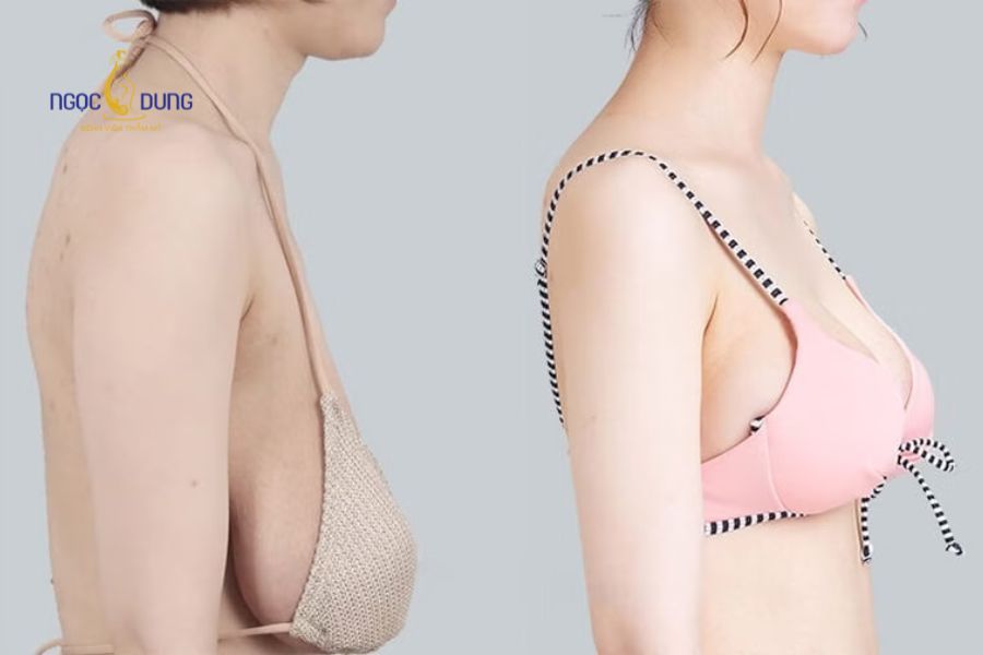 Nâng ngực chảy xệ sau sinh: Giải pháp lấy lại vòng 1 săn chắc 14 Phương pháp treo sa trễ hỗ trợ tái định vị mô tuyến vú và núm vú về vị trí cân đối tự nhiên