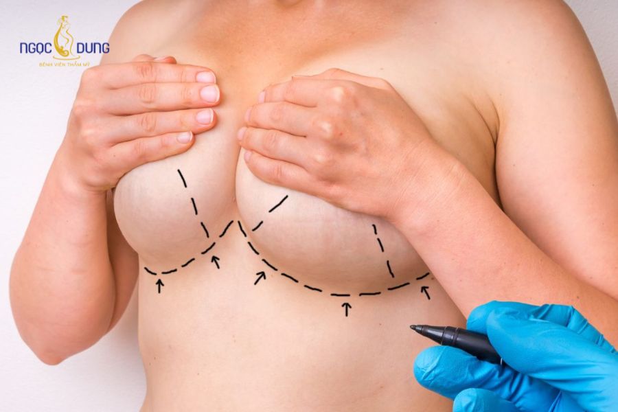 Nâng ngực đường quầng là gì? Ưu nhược điểm và quy trình 10 Quầng vú tập trung nhiều tuyến bã và vi khuẩn tự nhiên trên da, đòi hỏi quy trình vô trùng nghiêm ngặt