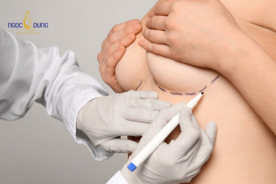 Nâng ngực size bao nhiêu thì đẹp? Chuẩn tỷ lệ vàng vòng 1 15 Rủi ro y khoa có thể xảy ra khi chọn sai kích thước túi độn không tương thích với lồng ngực
