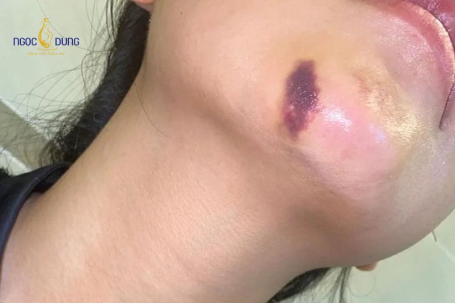 Dấu hiệu tiêm filler bị hoại tử và cách xử lý an toàn 10 Sự đổi màu da từ đỏ tấy sang thâm tím và cảm giác đau nhói lan xuống cổ khi cằm bị hoại tử