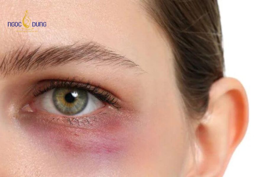 Dấu hiệu tiêm filler bị hoại tử và cách xử lý an toàn 11 Sưng nề mí mắt và suy giảm thị lực là tình huống cấp cứu nhãn khoa khẩn cấp