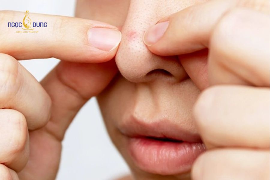 Tiêm filler mũi bị lệch: Nguyên nhân và cách khắc phục 9 Thói quen sờ nắn hay đè ép lên vùng mũi mới tiêm khiến filler bị xô lệch khỏi vị trí đích