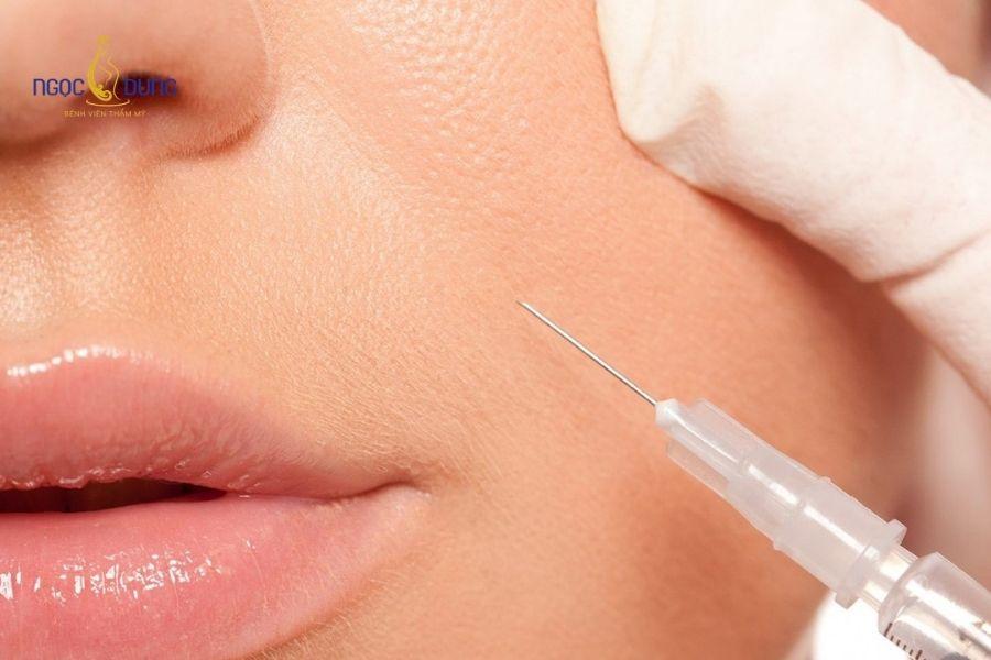 Tiêm filler rãnh cười bao nhiêu cc? Bảng giá chi tiết 13 Tiêm dư thừa chất làm đầy rãnh cười khiến nếp gấp mũi má bị gồ cứng và mất cân đối