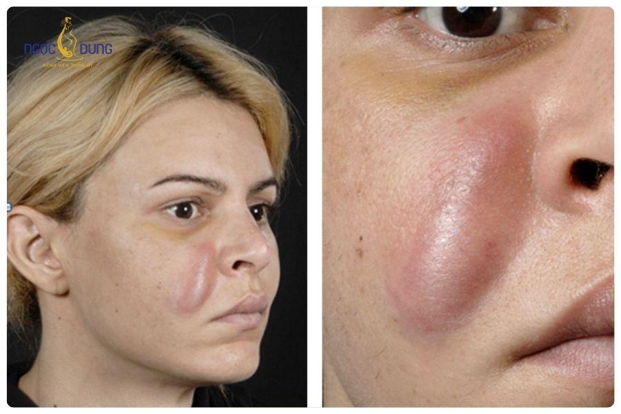 Tiêm filler giá bao nhiêu? Bảng giá cập nhật mới nhất 23 Cần lựa chọn bác sĩ giàu kinh nghiệm để tránh rủi ro biến chứng do sai kỹ thuật tiêm