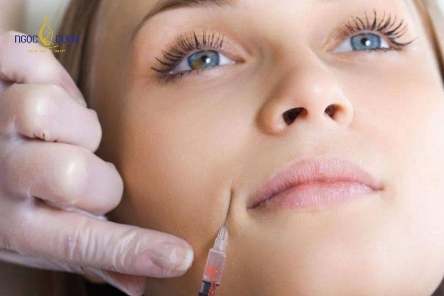 Tiêm filler rãnh cười: Hiệu quả, bảng giá, duy trì 14 Tiêm filler rãnh cười không phẫu thuật, không mất thời gian nghỉ dưỡng và thực hiện nhanh chóng