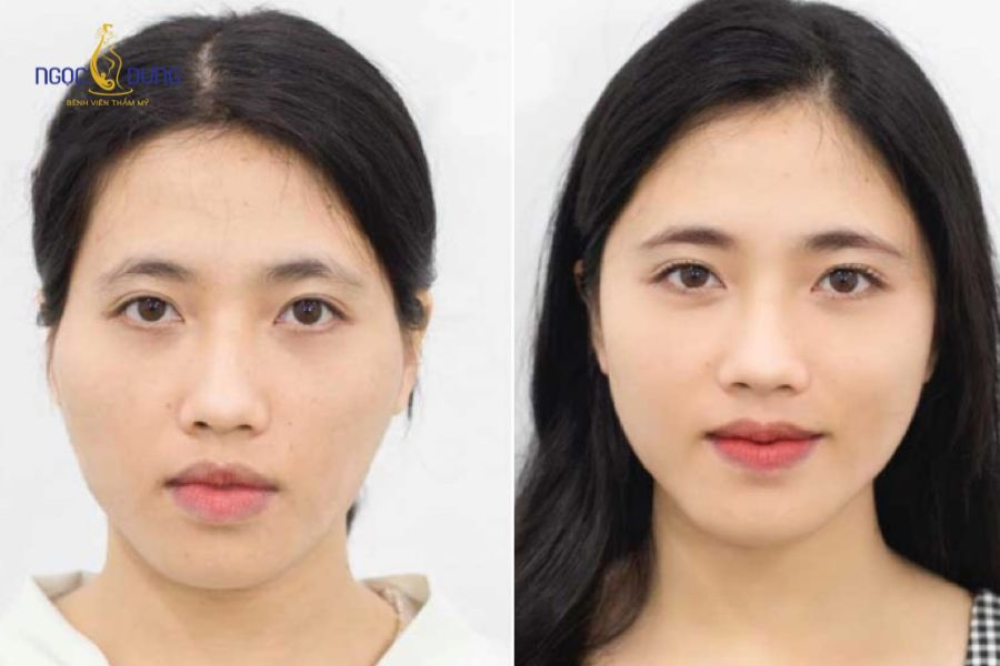 Tiêm filler thái dương: Tác dụng, quy trình và bảng giá 14 Tiêm filler thái dương giúp gương mặt tròn đầy