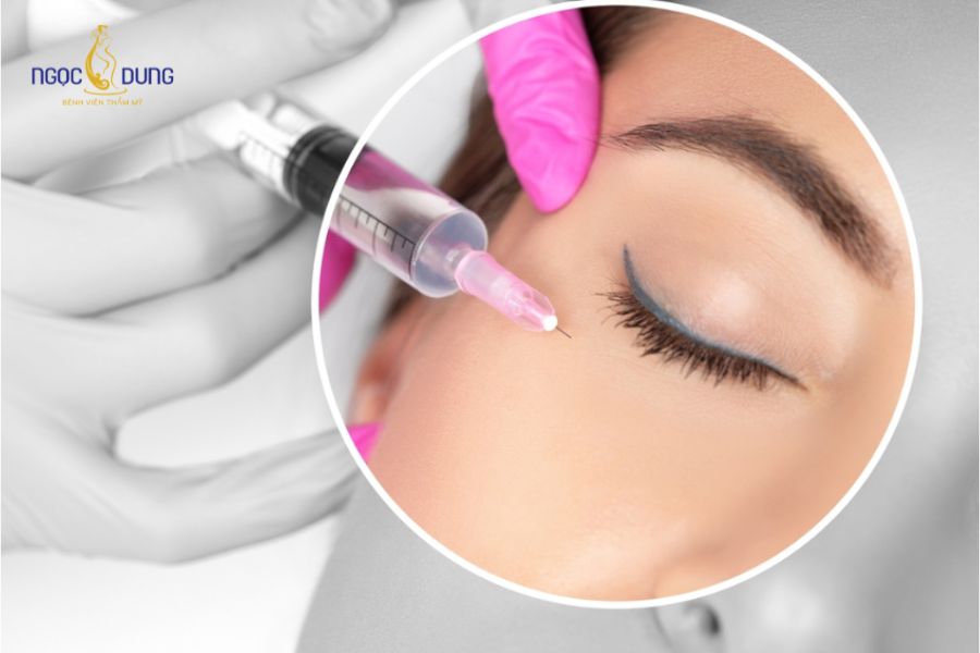 Tiêm filler có đau không? Nguyên nhân và cách giảm đau 13 Tiêm sai vị trí vào lòng mạch máu là biến chứng nghiêm trọng cần cấp cứu y khoa ngay lập tức