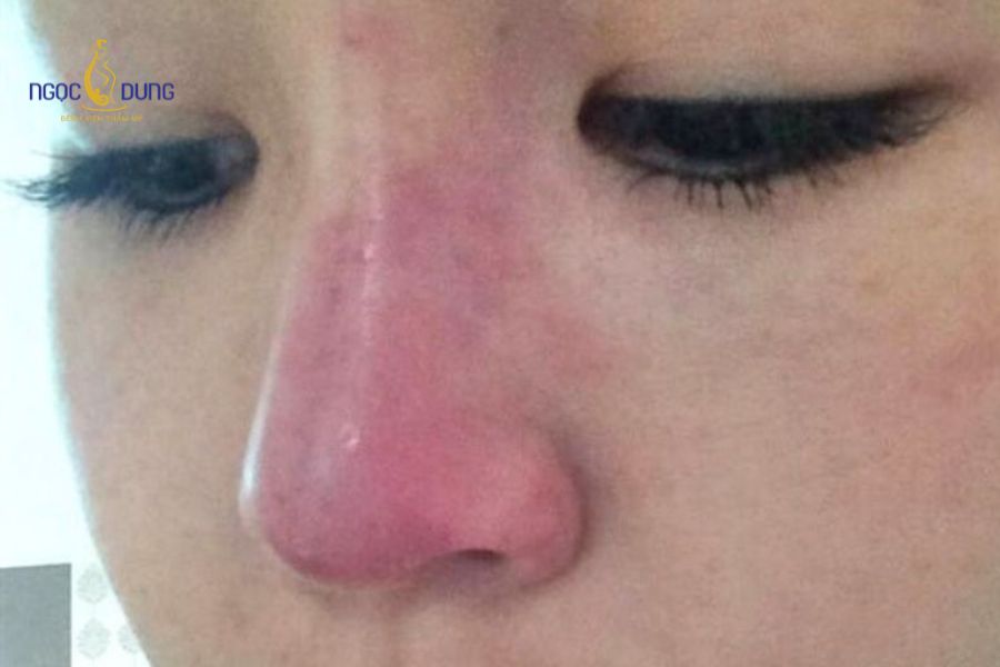 Tiêm filler mũi bị tràn: Nguyên nhân và cách khắc phục 11 Tràn filler khiến dáng mũi mất cân đối và để lại nguy cơ sẹo xấu