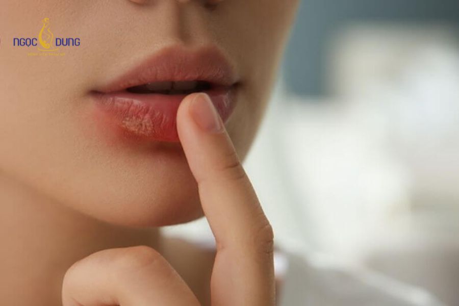 Tiêm filler bị nổi mụn nước có nguy hiểm không? Vì sao? 17 Tuân thủ chế độ vệ sinh và kiêng cữ sau tiêm giúp bảo vệ vùng da thẩm mỹ an toàn