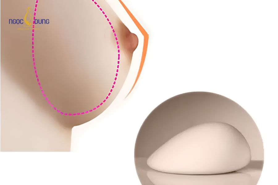 Nâng ngực giọt nước: Giải pháp vòng 1 căng tròn tự nhiên 13 Túi độn ngực hình giọt nước có thiết kế đỉnh thon đáy đầy mô phỏng cấu trúc ngực tự nhiên