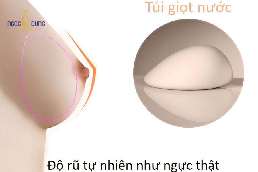 Nên nâng ngực túi tròn hay giọt nước? Lời khuyên chuyên gia 6 Túi ngực giọt nước tạo độ dốc mềm mại từ trên xuống dưới mô phỏng bầu ngực tự nhiên