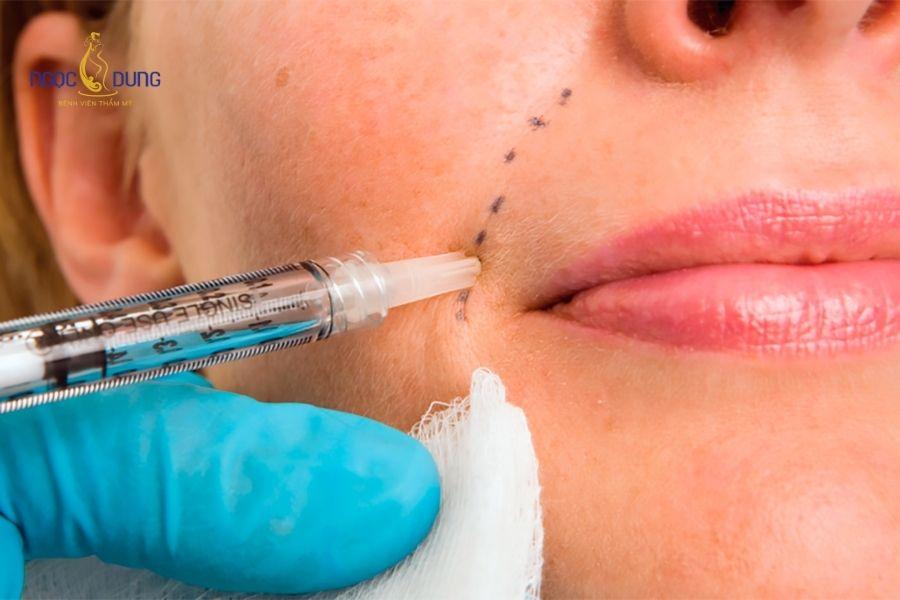 Tiêm filler rãnh cười bị sưng có gây nguy hiểm không? 9 Vùng tiêm bị sưng tấy lan rộng kèm bầm tím, đau nhức tăng dần là tín hiệu cần can thiệp y khoa khẩn cấp