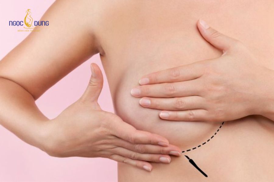 Nâng ngực chảy xệ sau sinh: Giải pháp lấy lại vòng 1 săn chắc 13 word image 13613 1