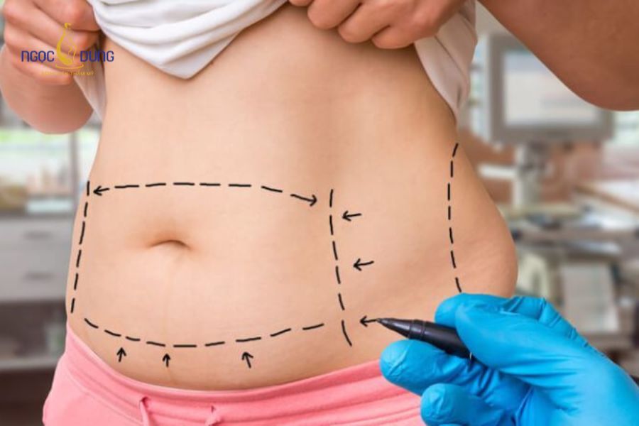Dịch vụ hút mỡ bụng an toàn, được đánh giá cao hiện nay 10 Bác sĩ kiểm tra chỉ số BMI và độ co hồi da bụng để xác định phương pháp hút mỡ phù hợp với từng khách hàng
