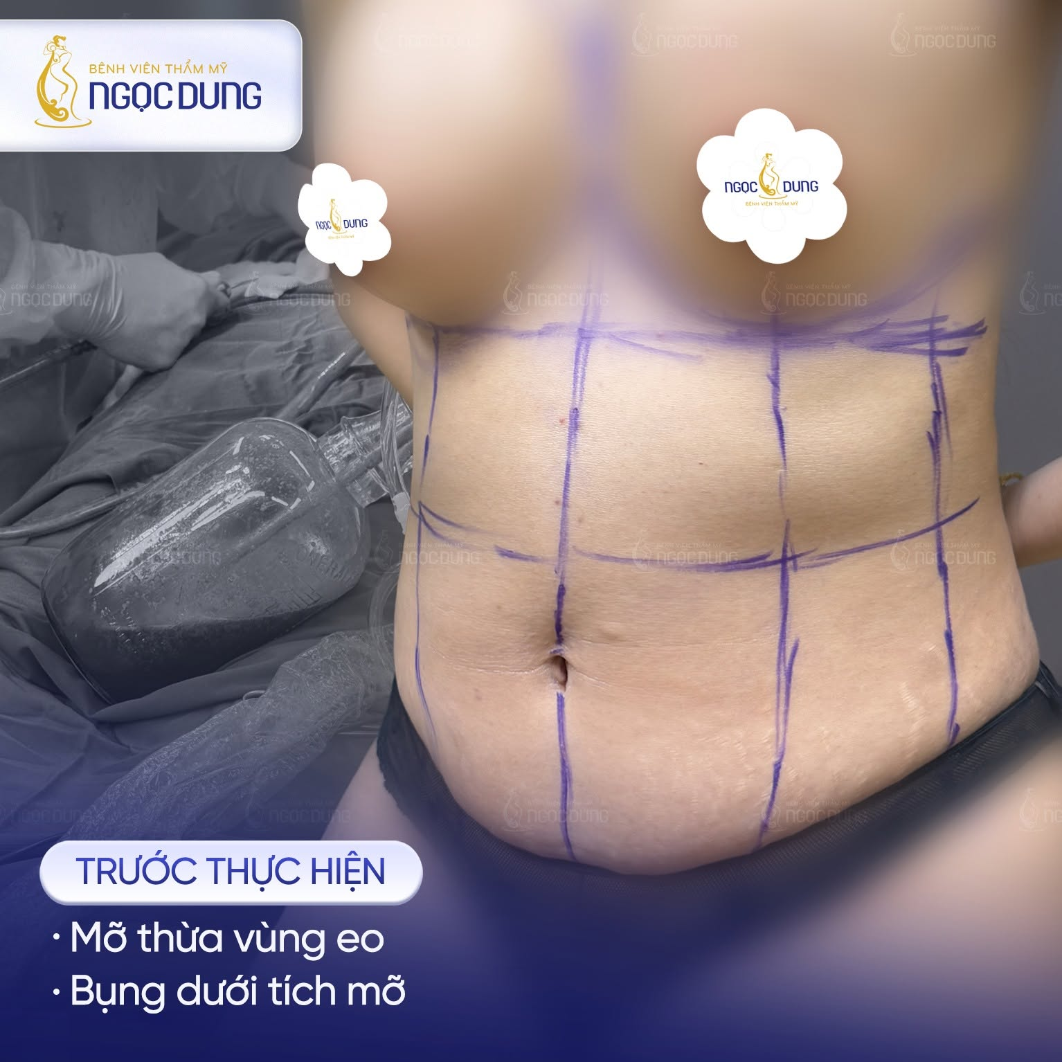 Hút mỡ bụng có nguy hiểm không? Đánh giá chuyên môn 9 Bác sĩ thăm khám và kiểm tra sức khỏe cẩn thận để đưa ra chỉ định hút mỡ thích hợp