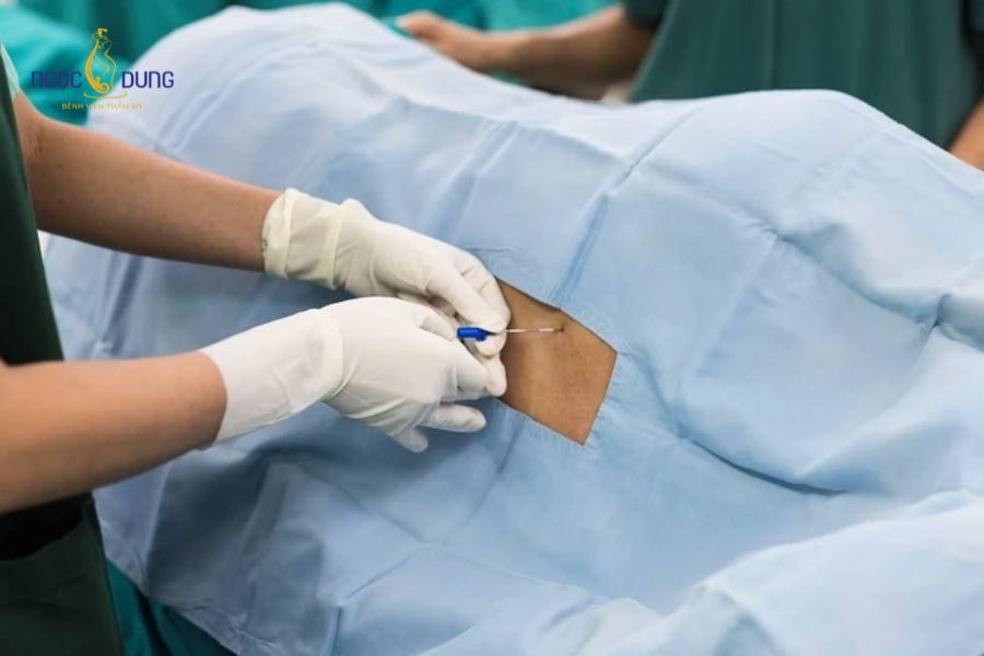 Khâu tầng sinh môn là gì? Cách chăm sóc để mau lành 13 Bác sĩ thực hiện gây tê cục bộ giúp sản phụ hạn chế cảm giác đau trong suốt quá trình thao tác