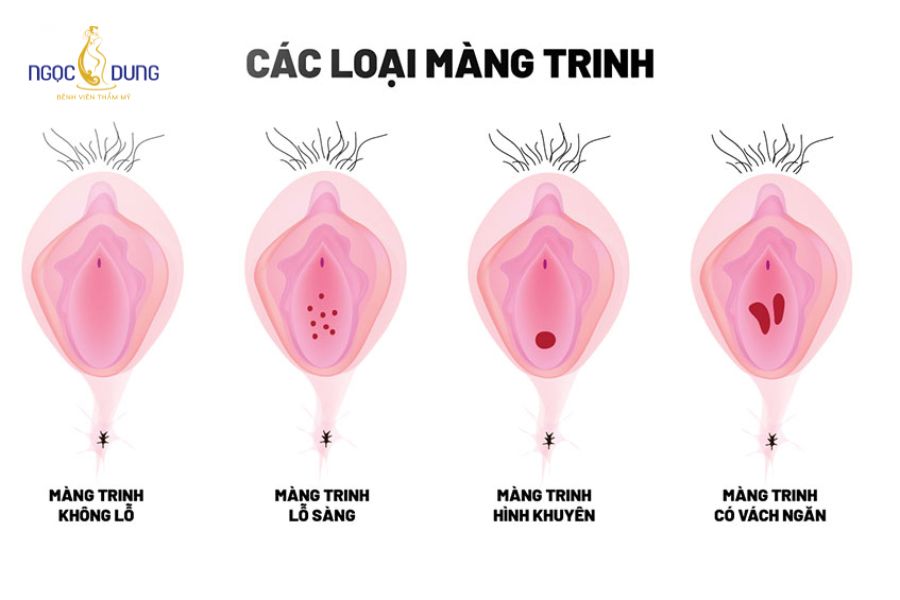 Các loại màng trinh ở phụ nữ: Cấu tạo và cách nhận biết 9 Các dạng cấu trúc màng trinh phổ biến và những ảnh hưởng sinh lý tương ứng