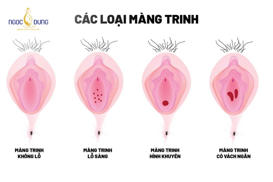 Rách màng trinh: Dấu hiệu, nguyên nhân và cách xử lý 11 Các dạng hình thái màng trinh phổ biến ở phụ nữ như hình vành khuyên, vách ngăn, lỗ sàng