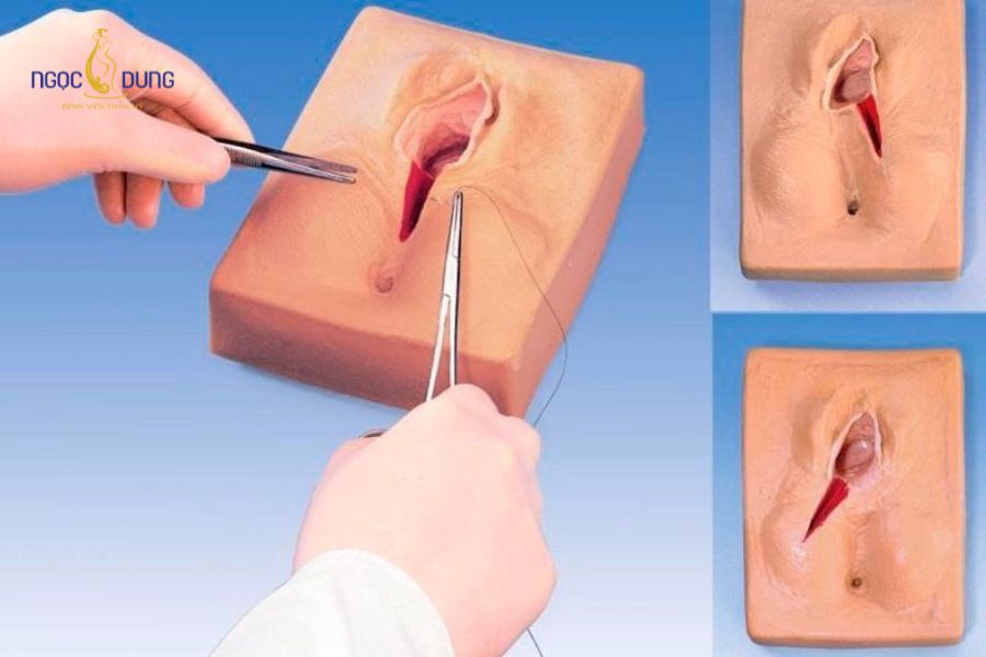 Chỉ tự tiêu tầng sinh môn bao lâu thì tiêu hết? Vì sao? 7 Các yếu tố sinh học và thói quen sinh hoạt tác động trực tiếp đến tốc độ tự phân hủy của chỉ