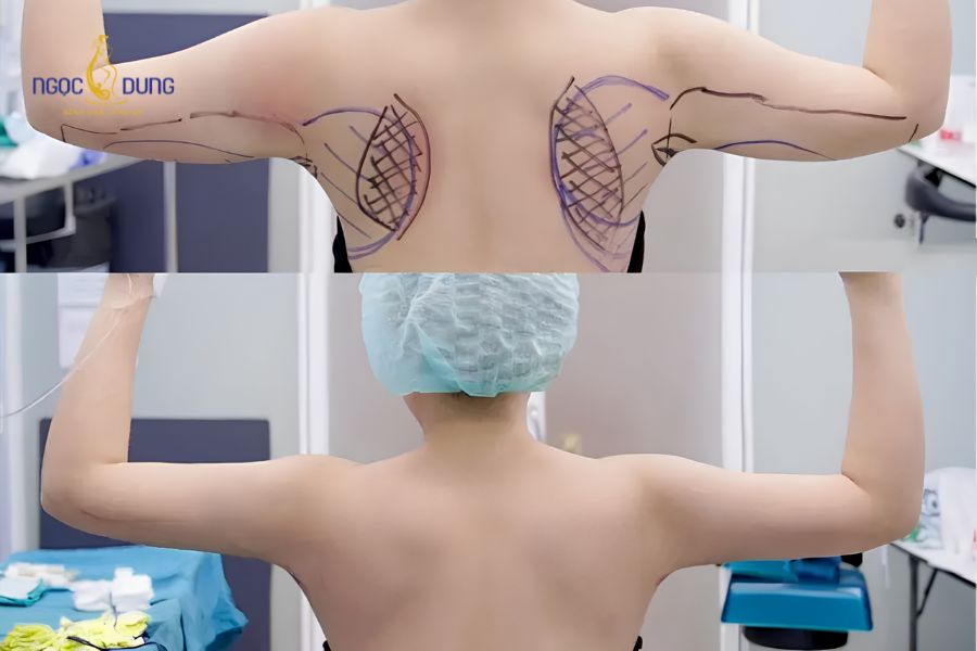 Có nên hút mỡ bắp tay không? Giải đáp chi tiết, đầy đủ 11 Cánh tay trở nên thon gọn, cân đối hơn với tổng thể vóc dáng sau khi phẫu thuật