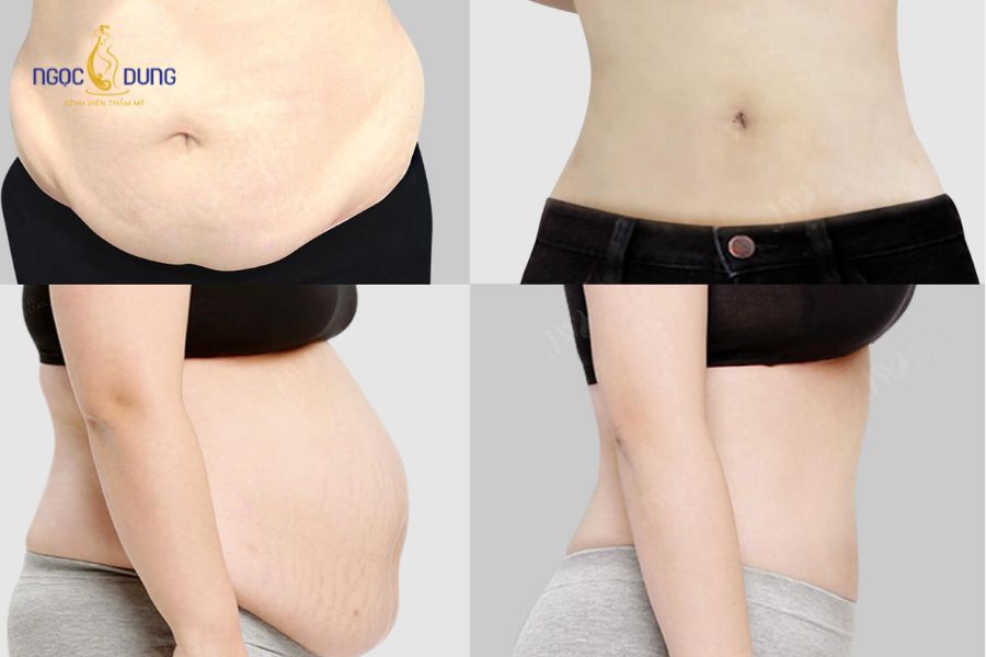 Hút mỡ bụng có đau không? Cách giảm đau, phục hồi nhanh 11 Chế độ chăm sóc hậu phẫu khoa học giúp rút ngắn thời gian phục hồi và tạo phom dáng bụng thon gọn