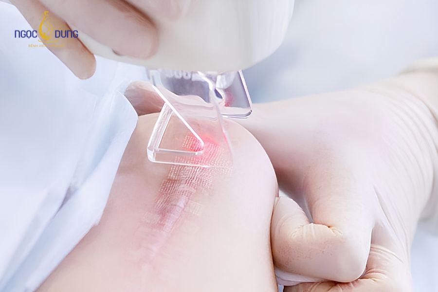 Hút mỡ bụng có để lại sẹo không? Giải đáp chuyên môn 11 Công nghệ Laser vi điểm hỗ trợ làm phẳng bề mặt sẹo và cải thiện sắc tố da không đều màu