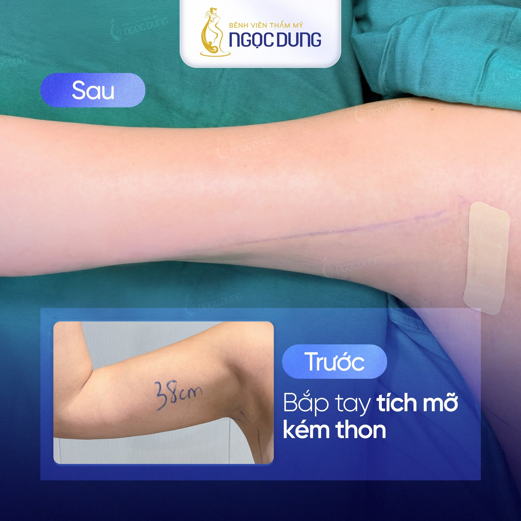 Hút mỡ bắp tay kiêng ăn gì để nhanh hồi phục, không sẹo 11 Đeo gen định hình và vệ sinh vết mổ theo đúng chỉ định của bác sĩ giúp bắp tay lên phom săn chắc
